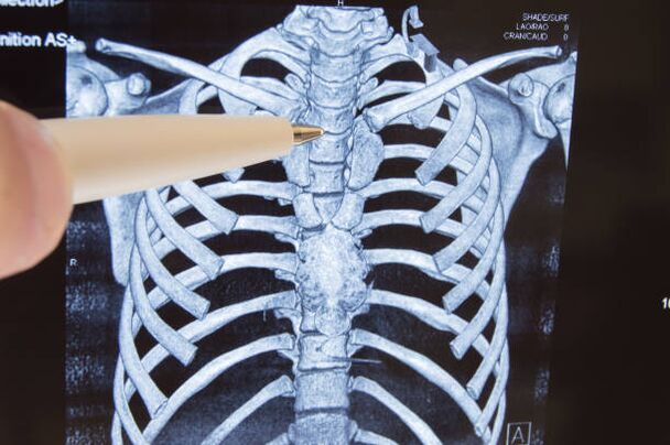 mugurkaula krūšu daļas osteohondroze