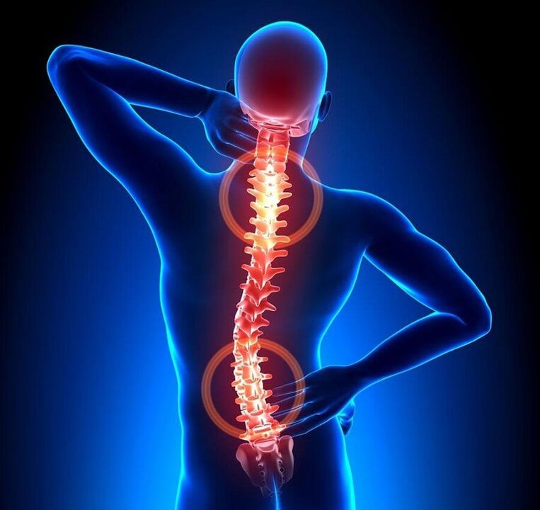 mugurkaula osteohondroze kā muguras sāpju cēlonis