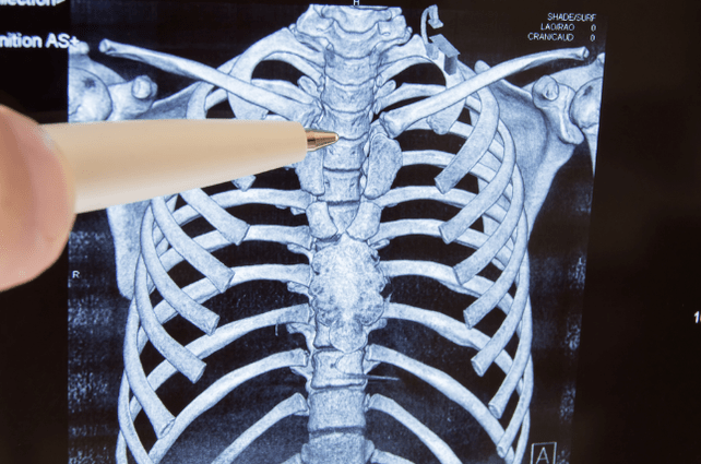 Osteohondroze